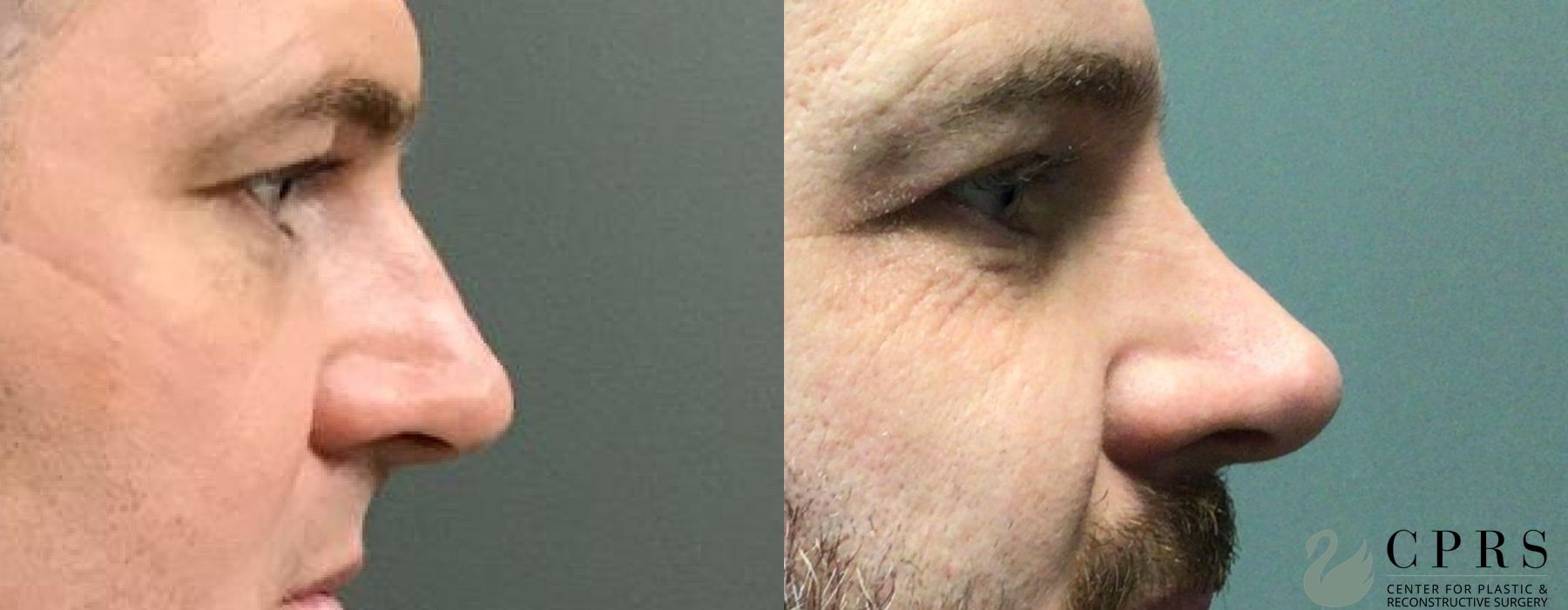 Before and after Rhinoplasty case 19085 - Angle 3