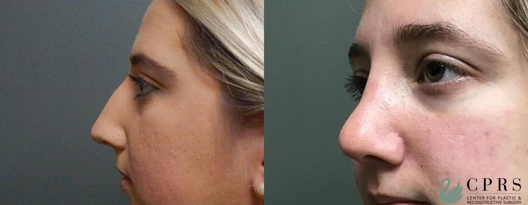 Before and after Rhinoplasty case 19077 - Angle 2