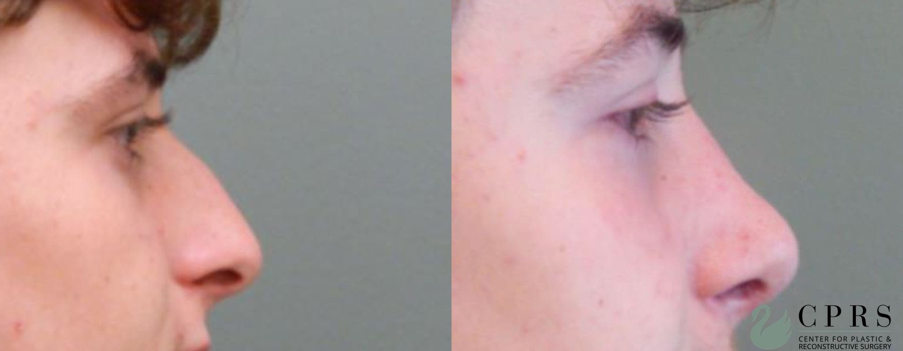Before and after Rhinoplasty case 18956