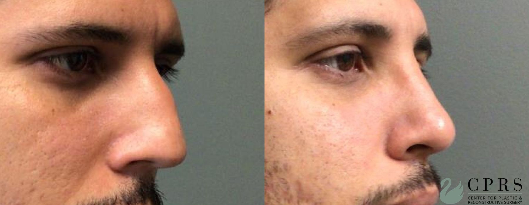 Before and after Rhinoplasty case 19075