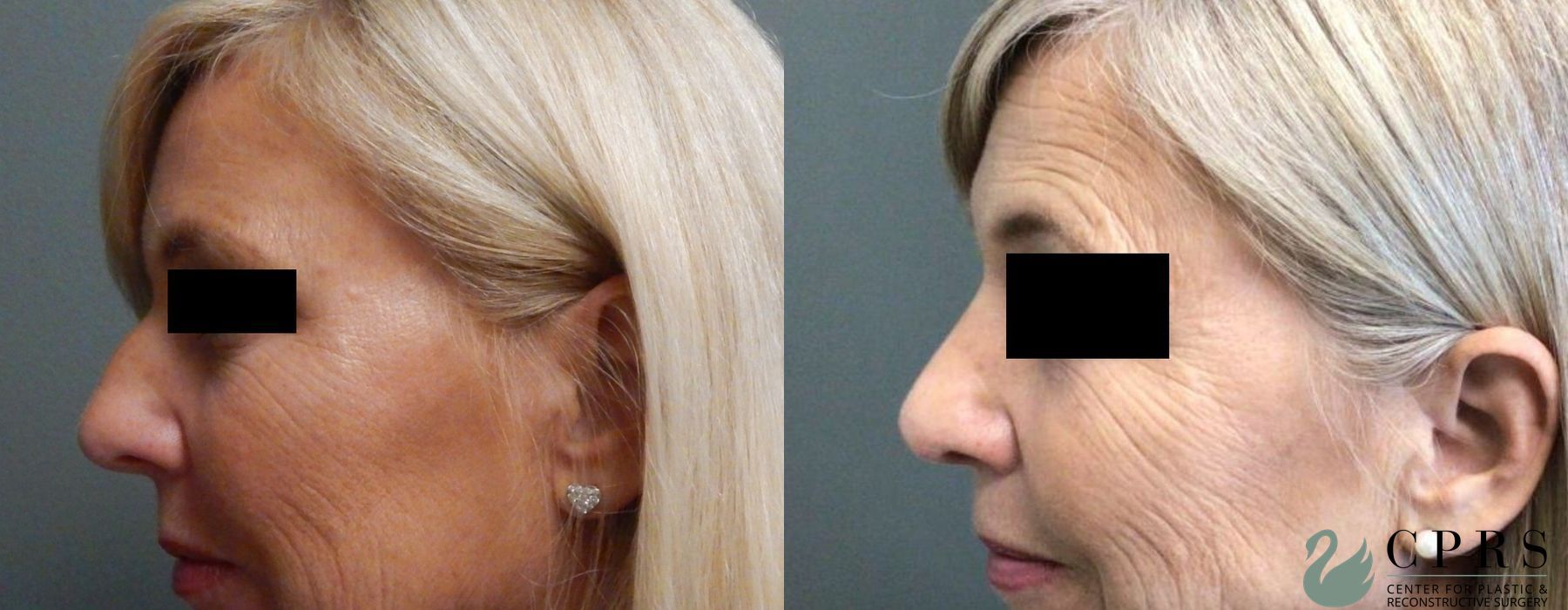 Before and after Rhinoplasty case 19124 - Angle 3