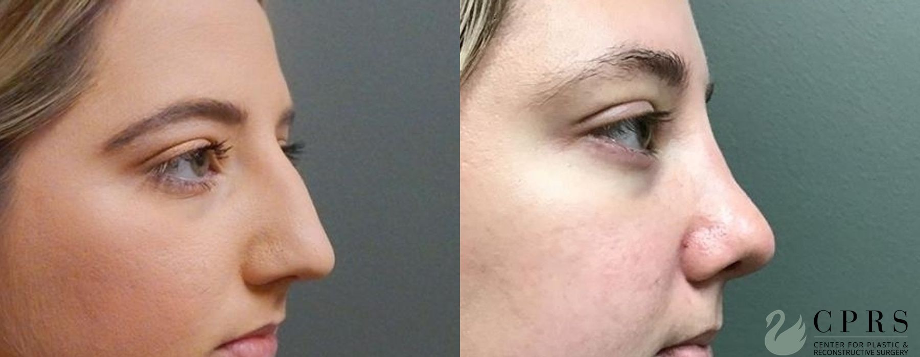 Before and after Rhinoplasty case 19077