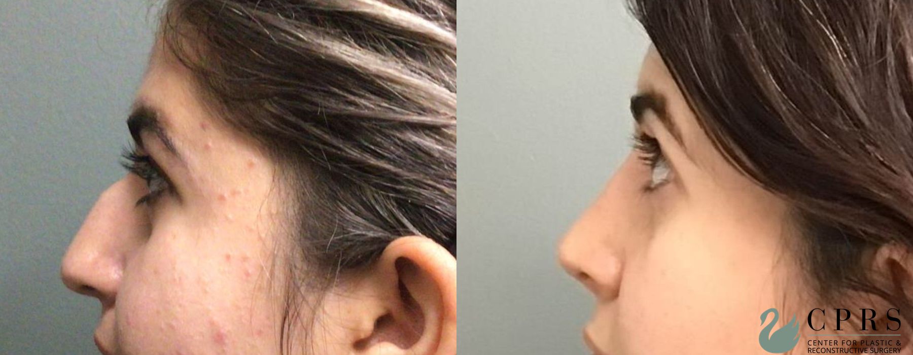 Before and after Rhinoplasty case 19131 - Angle 3