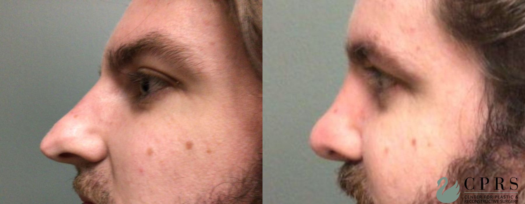 Before and after Rhinoplasty case 19137