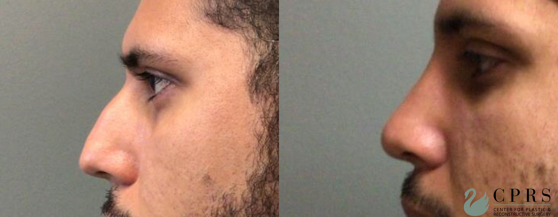 Before and after Rhinoplasty case 19075 - Angle 3