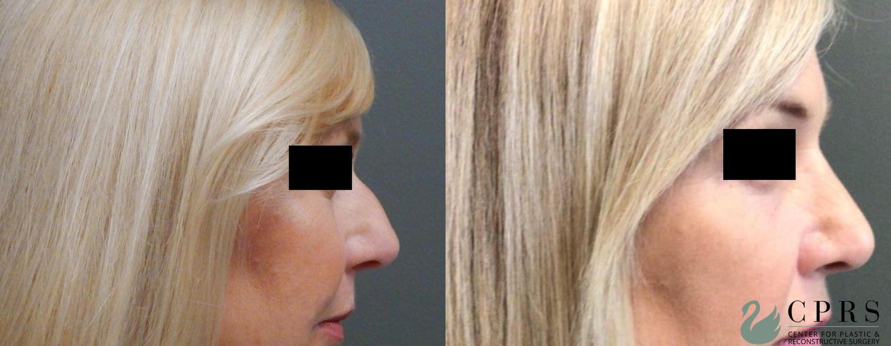 Before and after Rhinoplasty case 19124