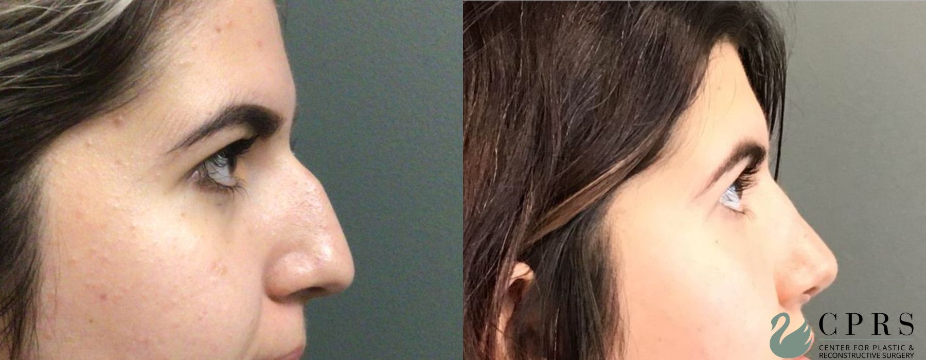 Before and after Rhinoplasty case 19131