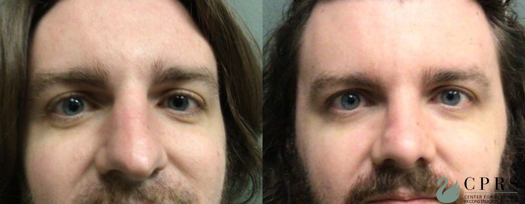 Before and after Rhinoplasty case 19137 - Angle 2