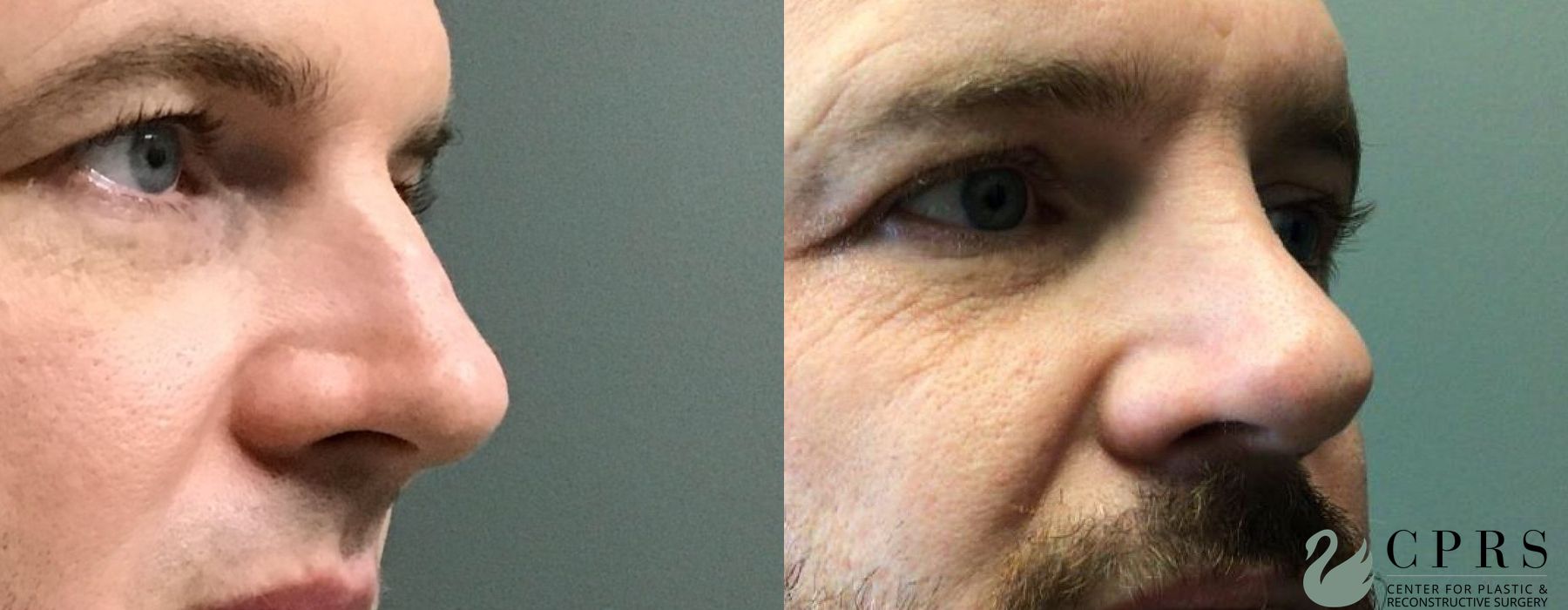 Before and after Rhinoplasty case 19085