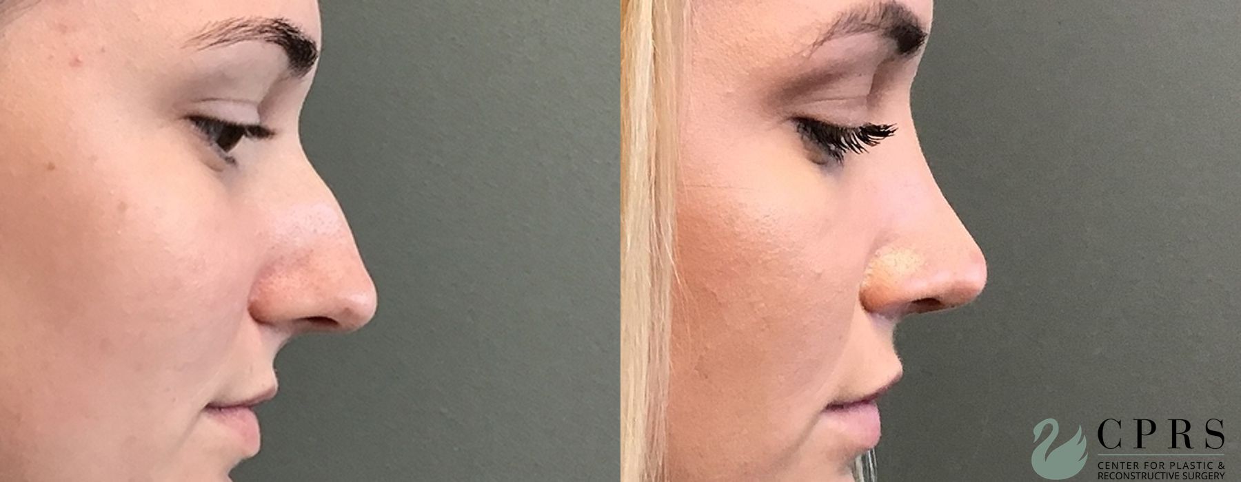 Before and after Rhinoplasty case 18947 - Angle 2