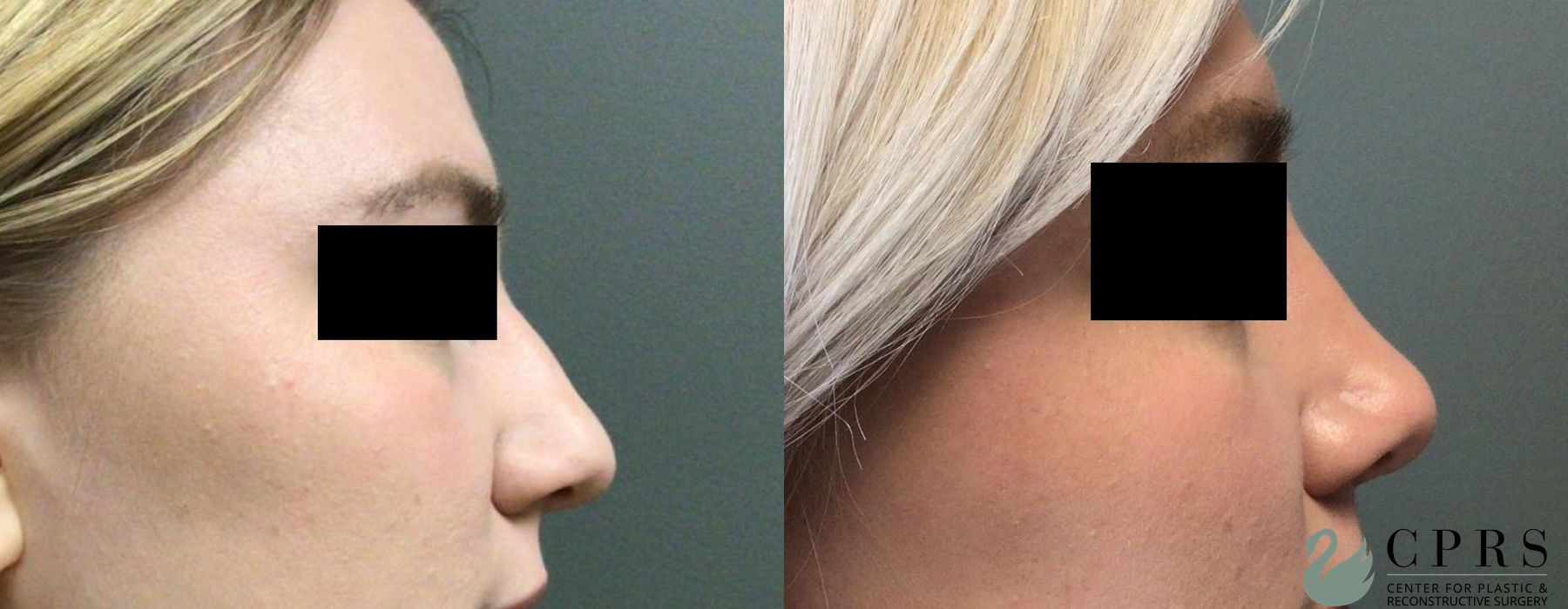 Before and after Rhinoplasty case 19027