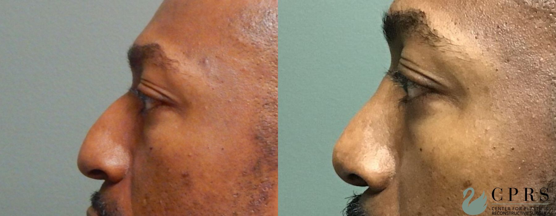 Before and after Rhinoplasty case 18932 - Angle 3
