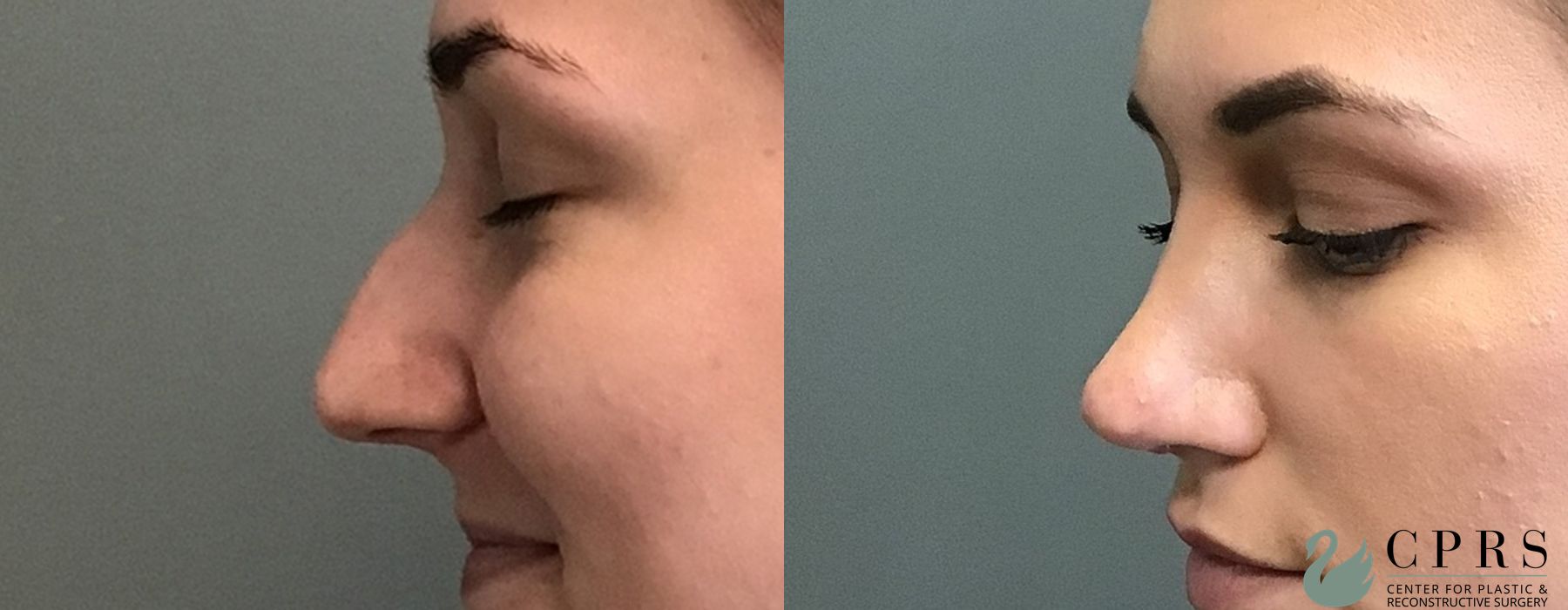 Before and after Rhinoplasty case 18947