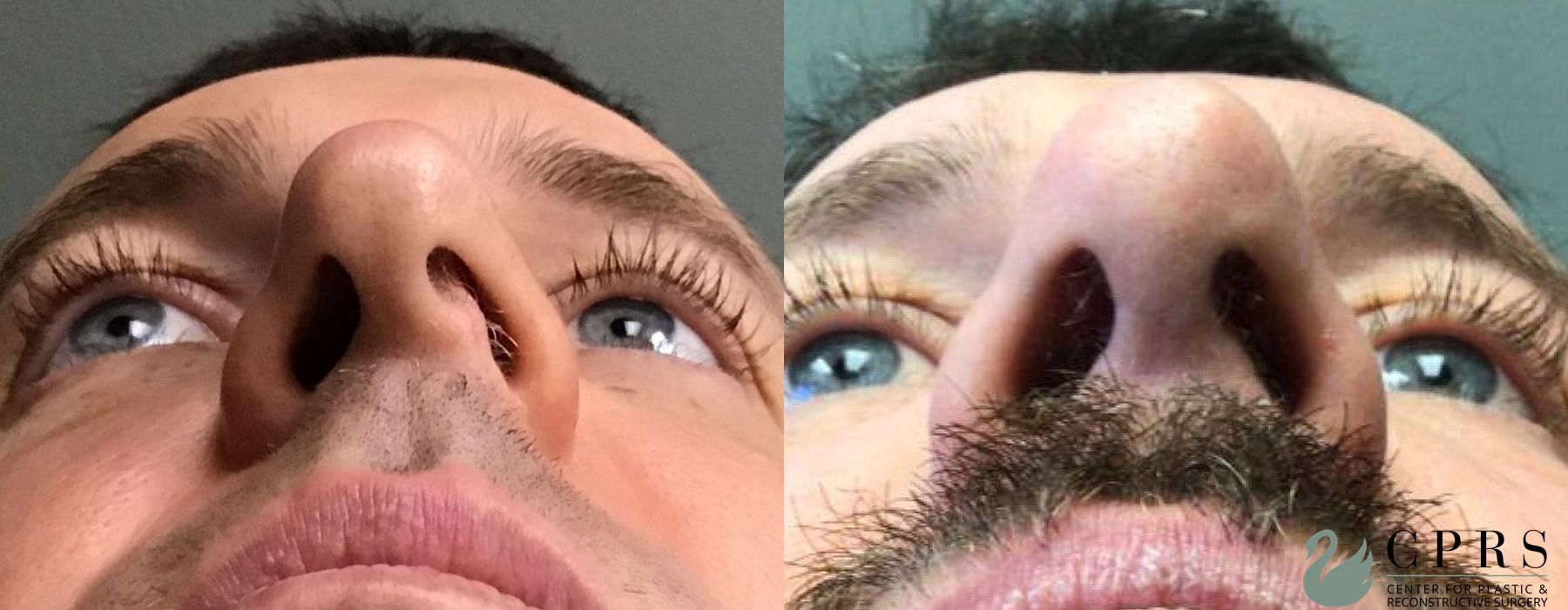 Before and after Rhinoplasty case 19085 - Angle 2