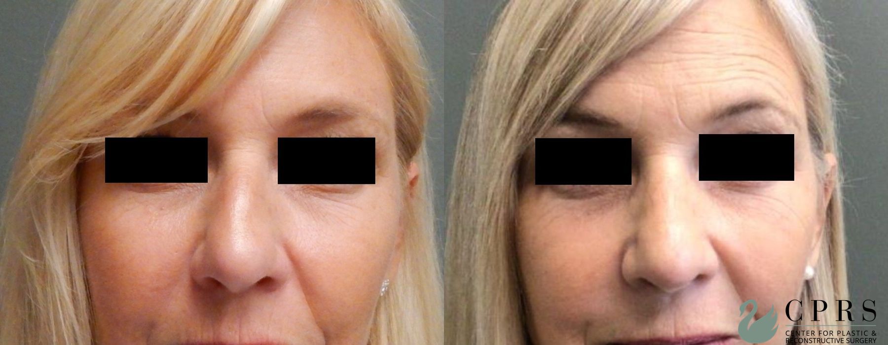Before and after Rhinoplasty case 19124 - Angle 2