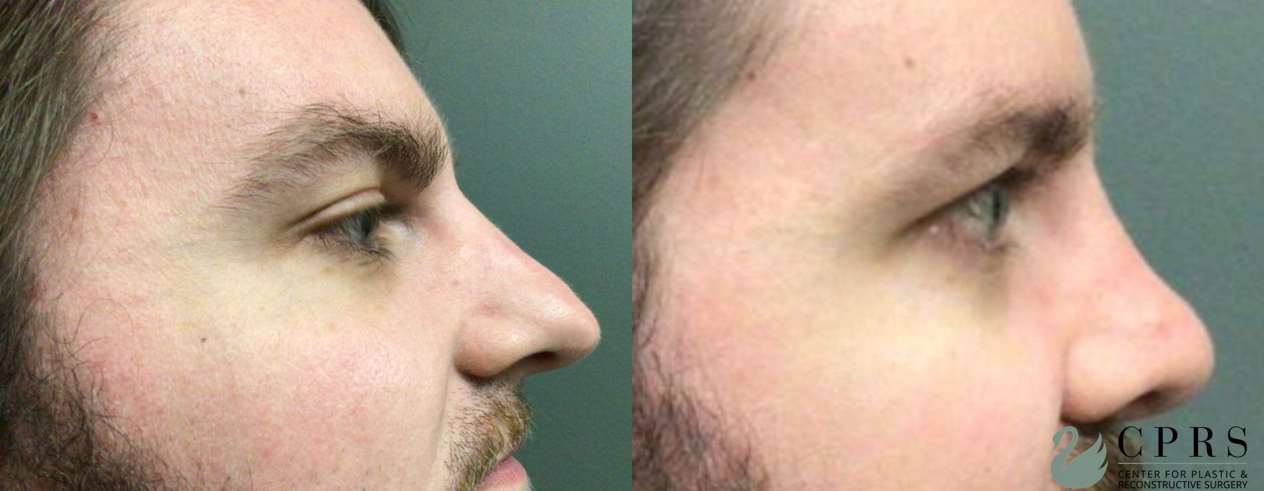 Before and after Rhinoplasty case 19137 - Angle 3