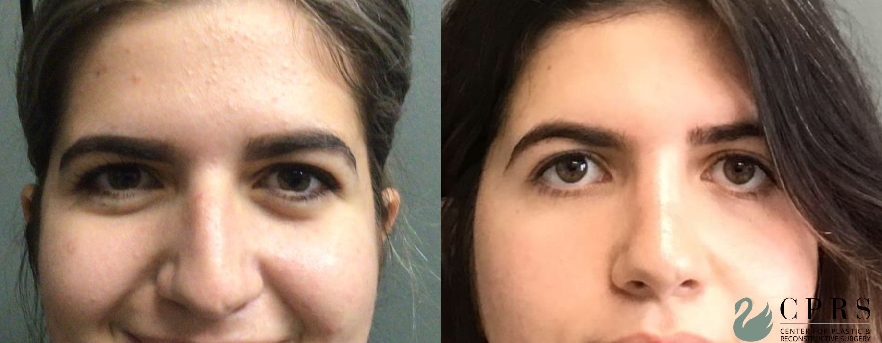 Before and after Rhinoplasty case 19131 - Angle 2