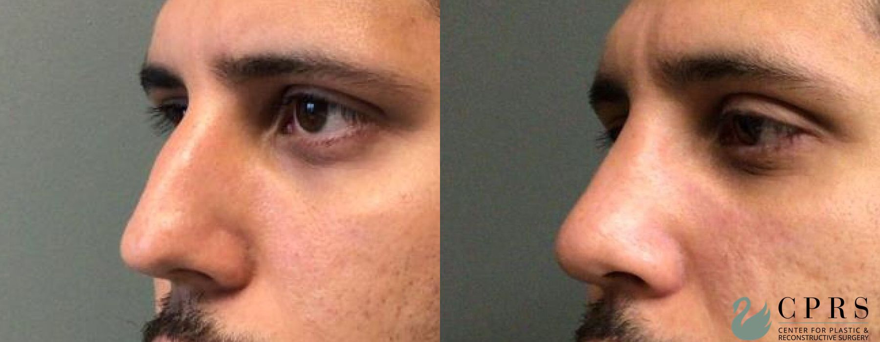 Before and after Rhinoplasty case 19075 - Angle 4