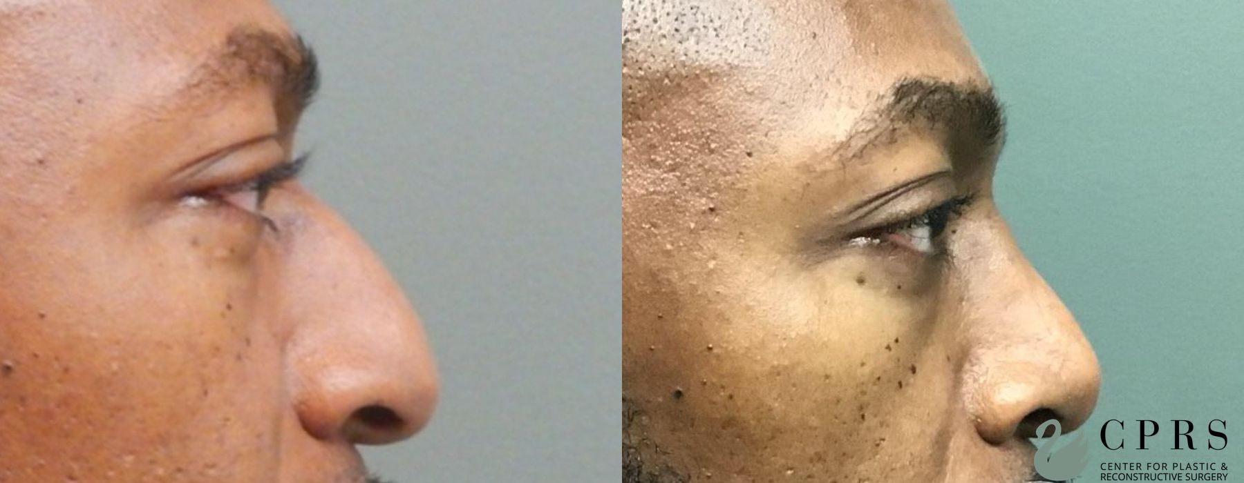 Before and after Rhinoplasty case 18932