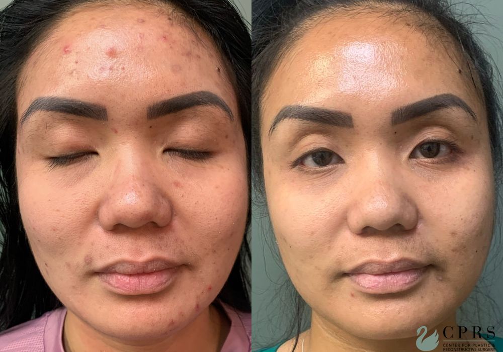 VI Peel - Case 239802