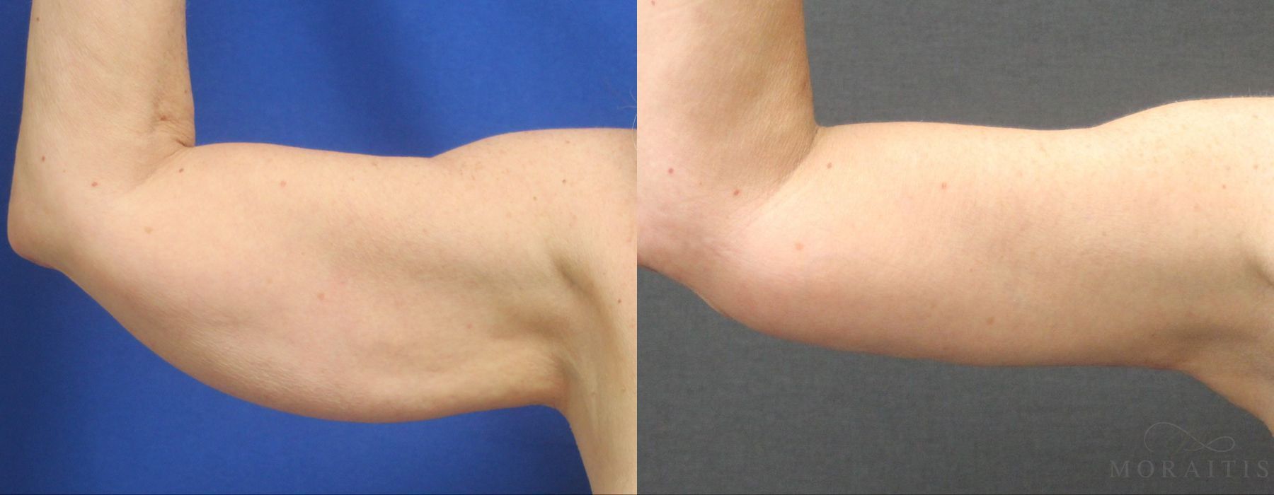 Arm Lift - Case 15285