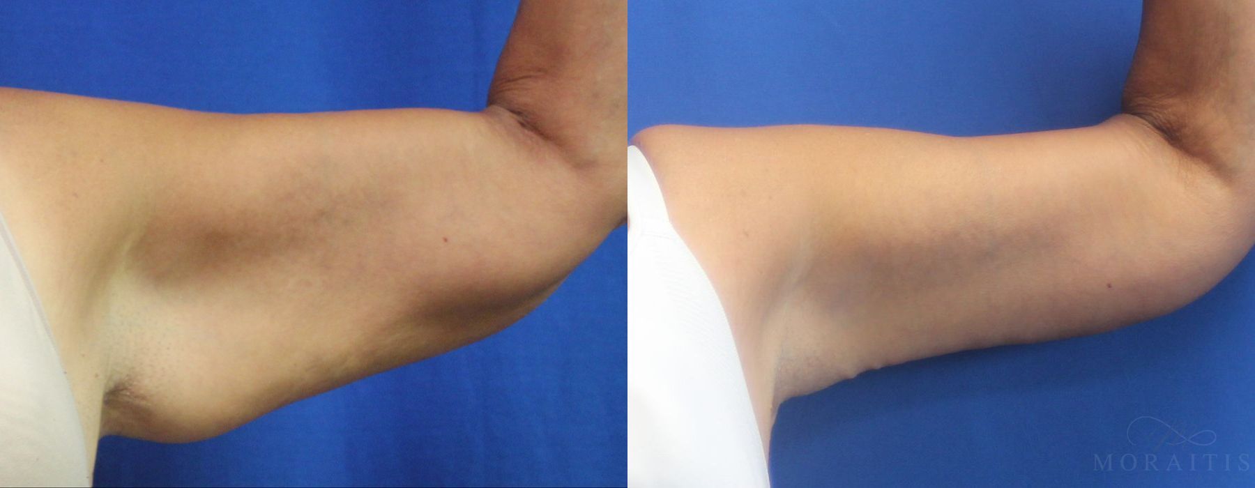 Arm Lift - Case 15284