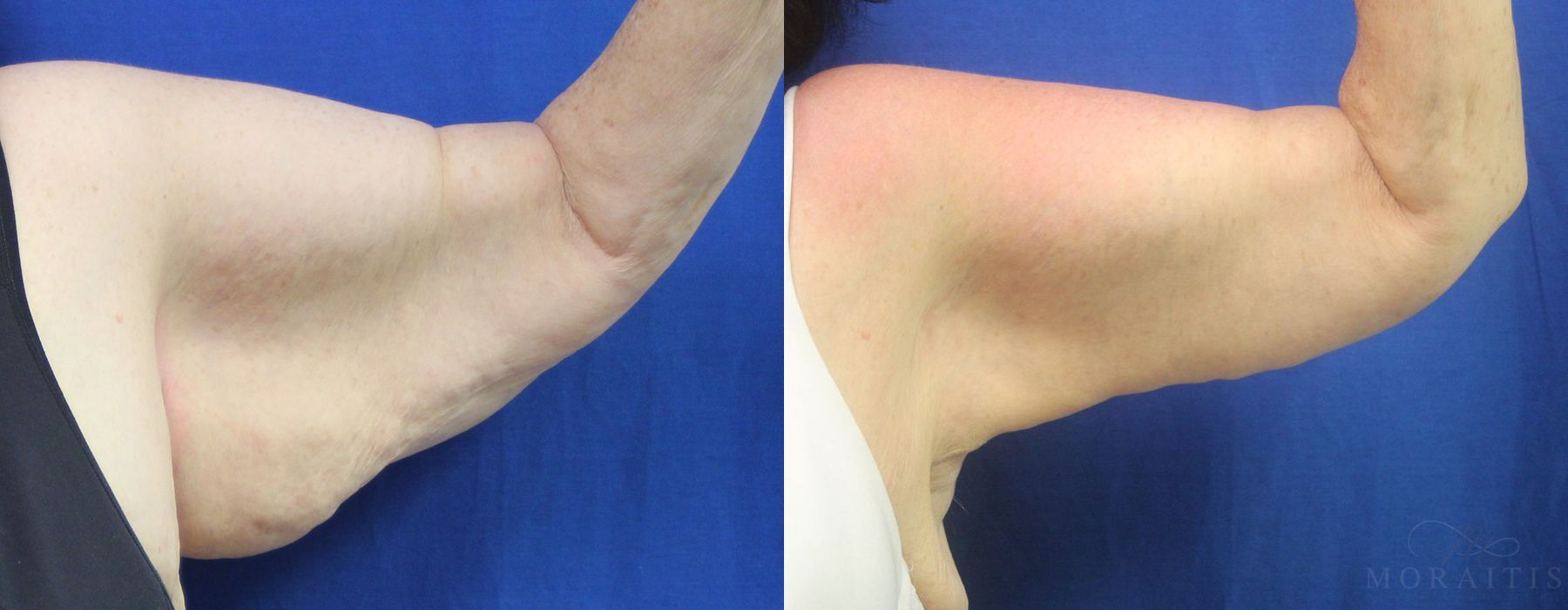 Arm Lift - Case 15290