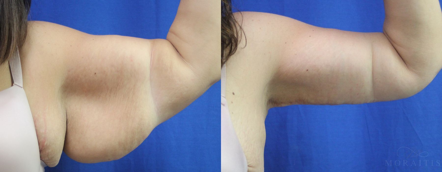 Arm Lift - Case 15282