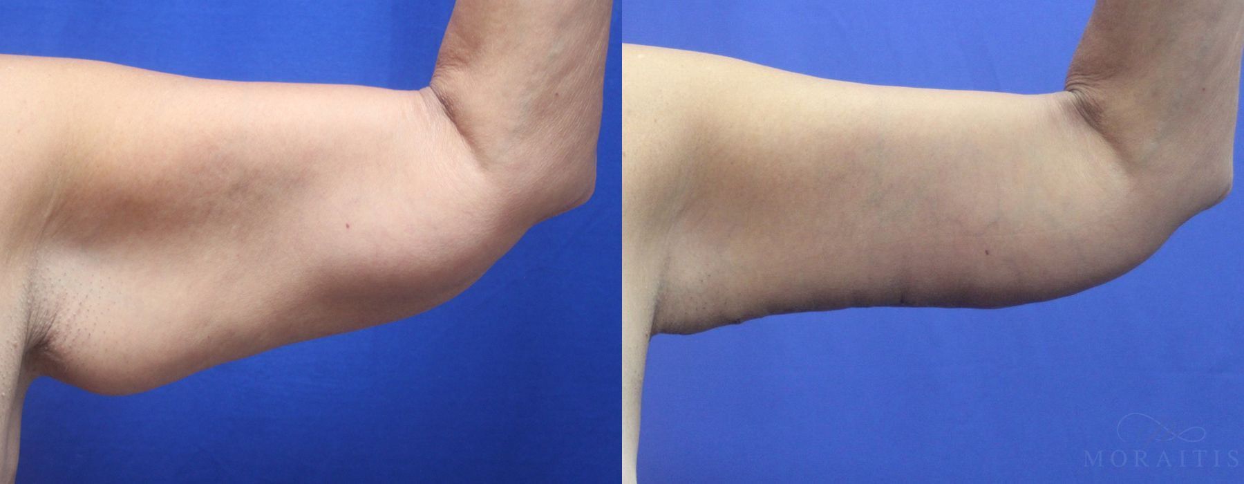 Arm Lift - Case 15293