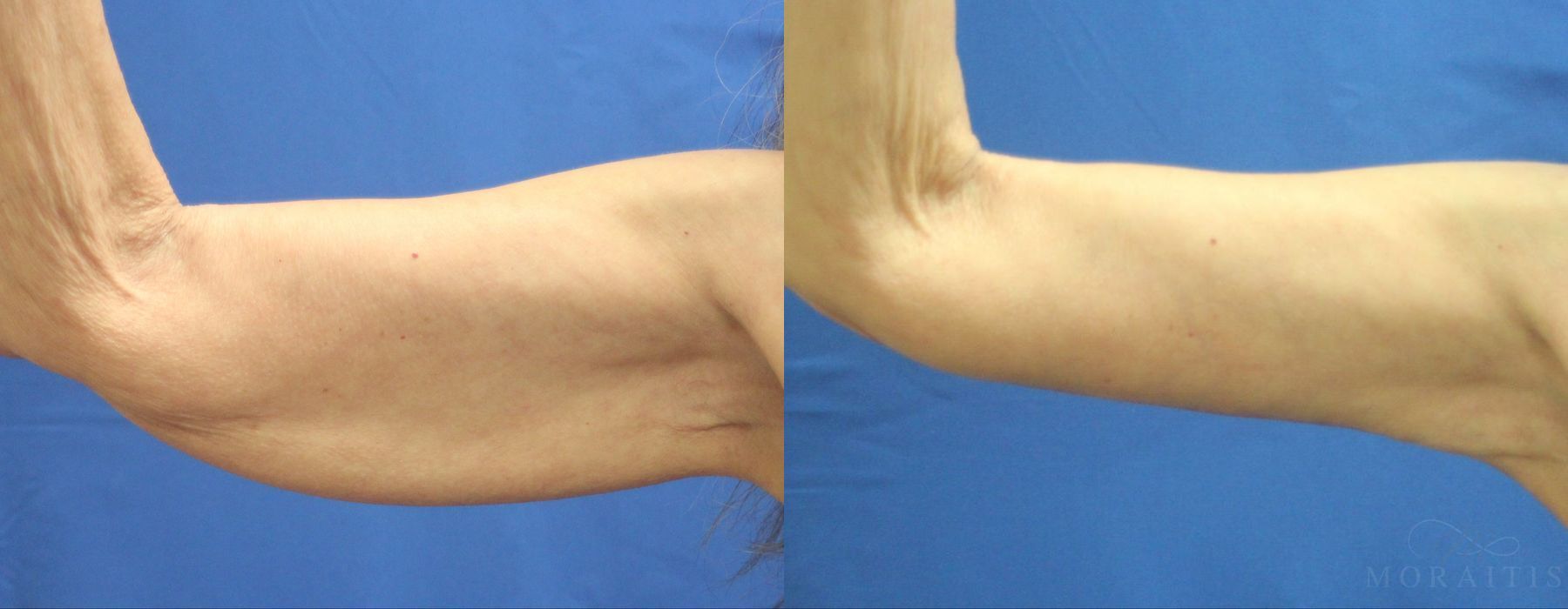 Arm Lift - Case 15298