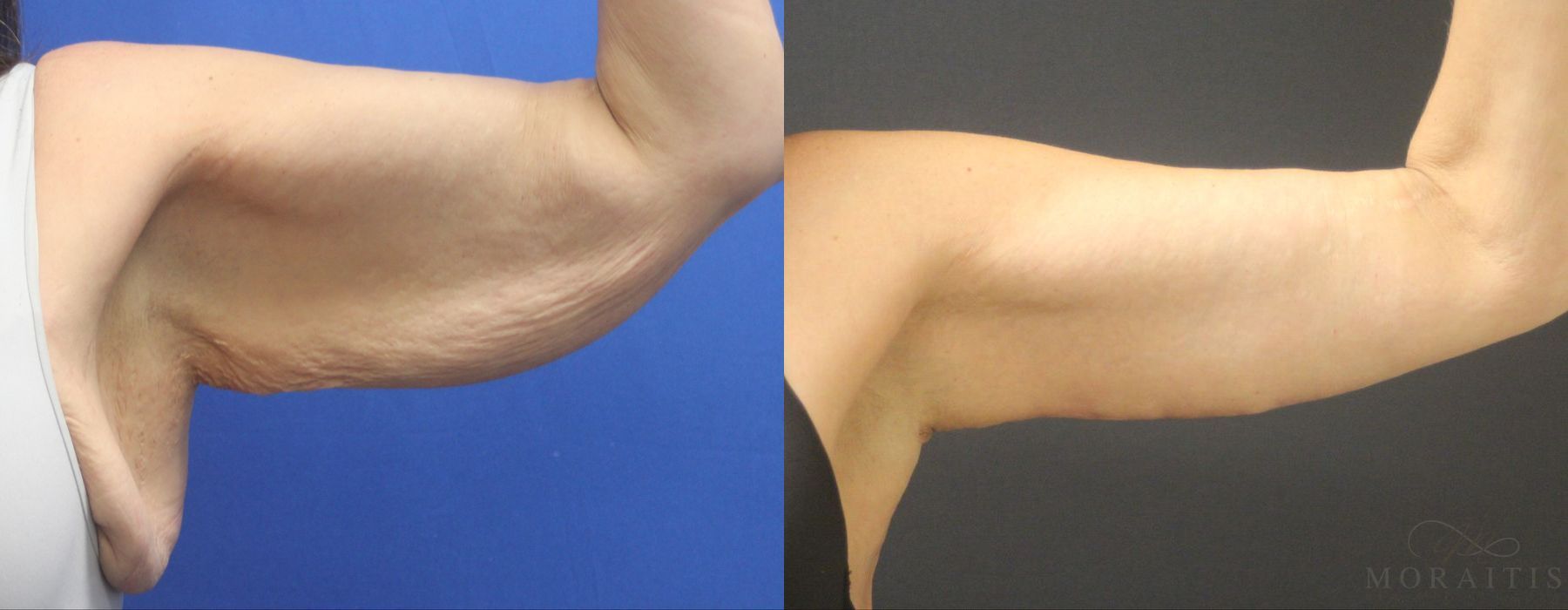 Arm Lift - Case 15287