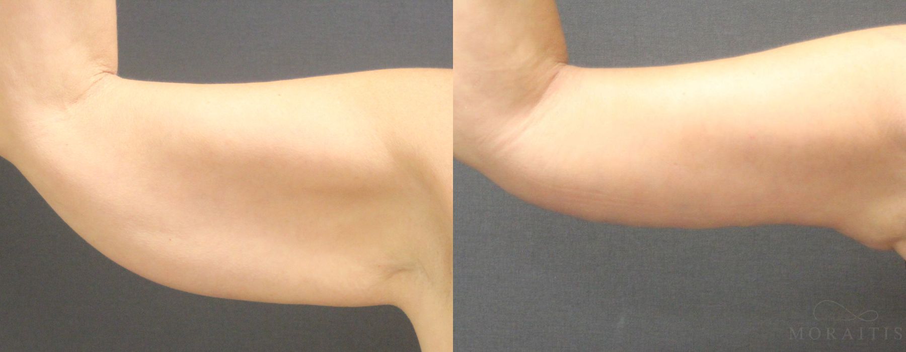 Arm Lift - Case 15289