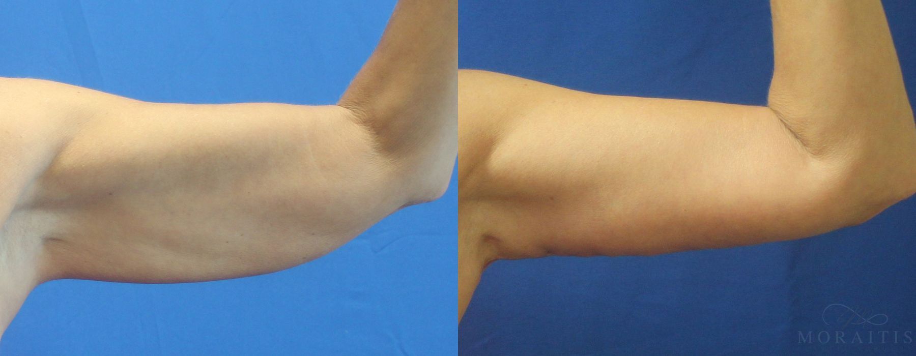 Arm Lift - Case 15297