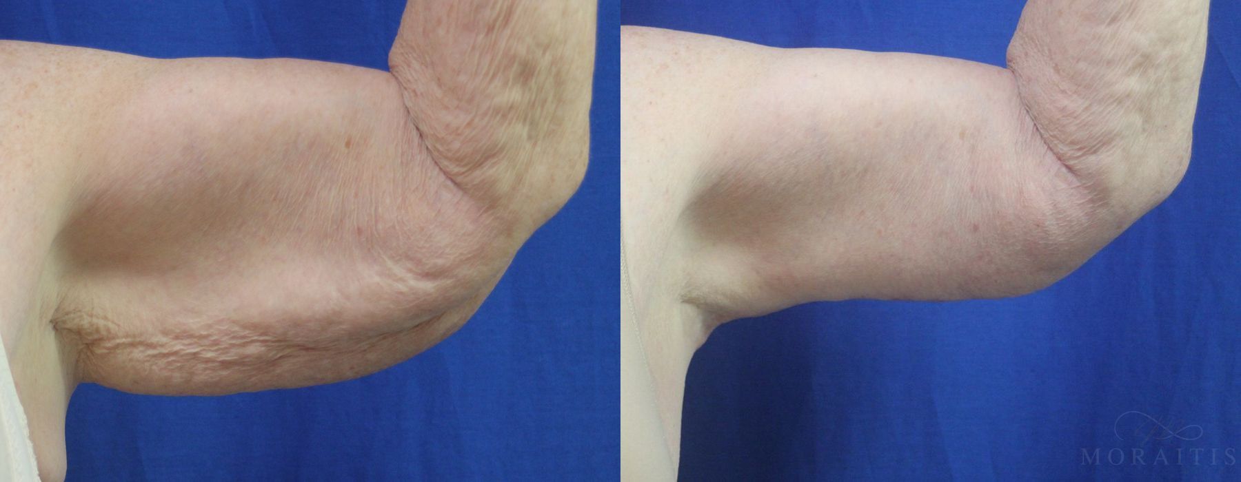 Arm Lift - Case 15292