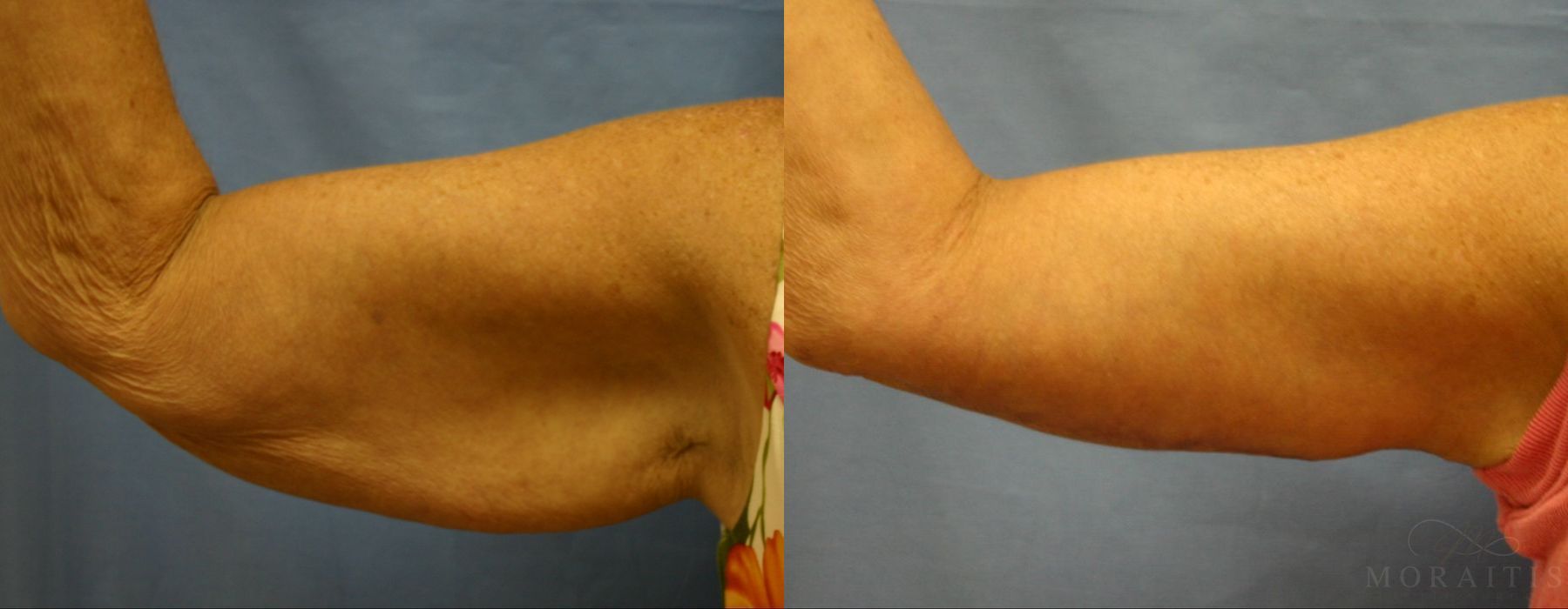 Arm Lift - Case 15278