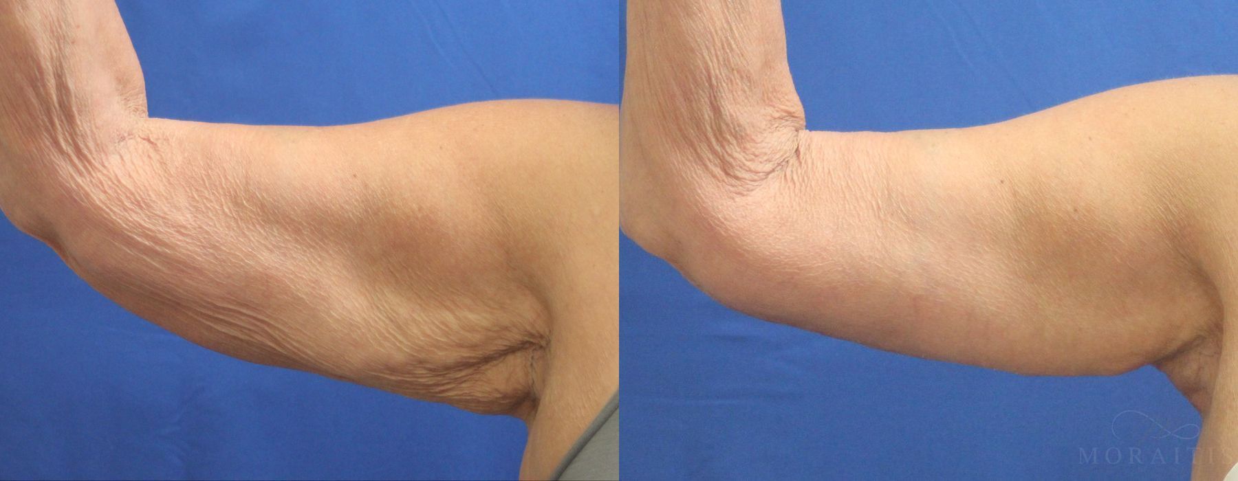 Arm Lift - Case 15286