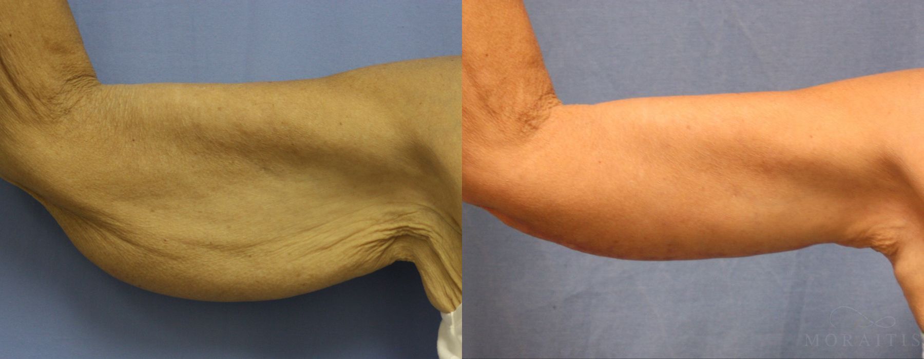 Arm Lift - Case 15279