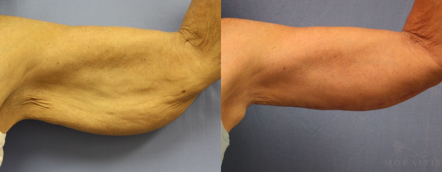 Arm Lift - Case 15294