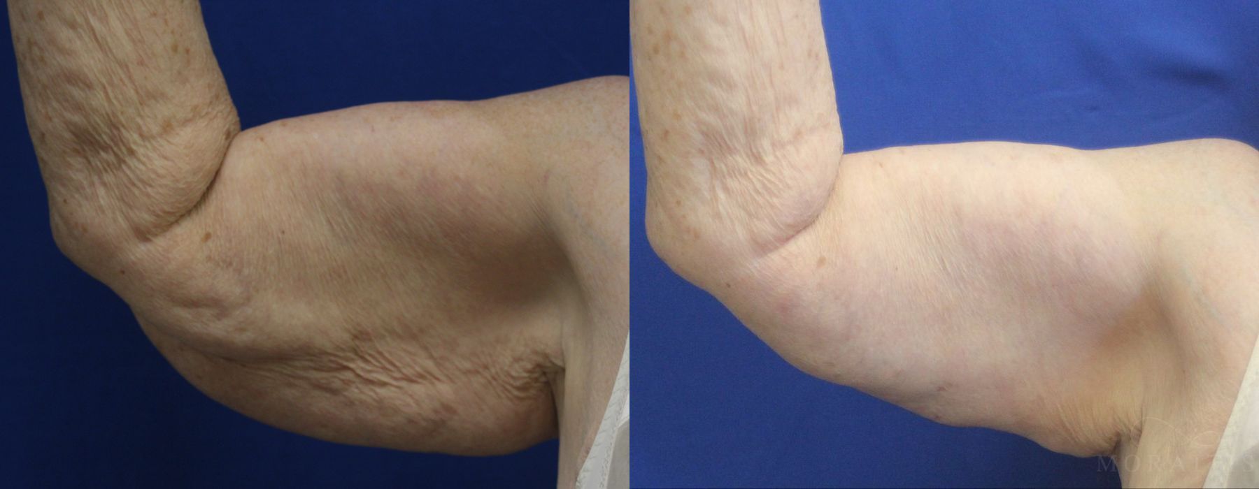 Arm Lift - Case 15283