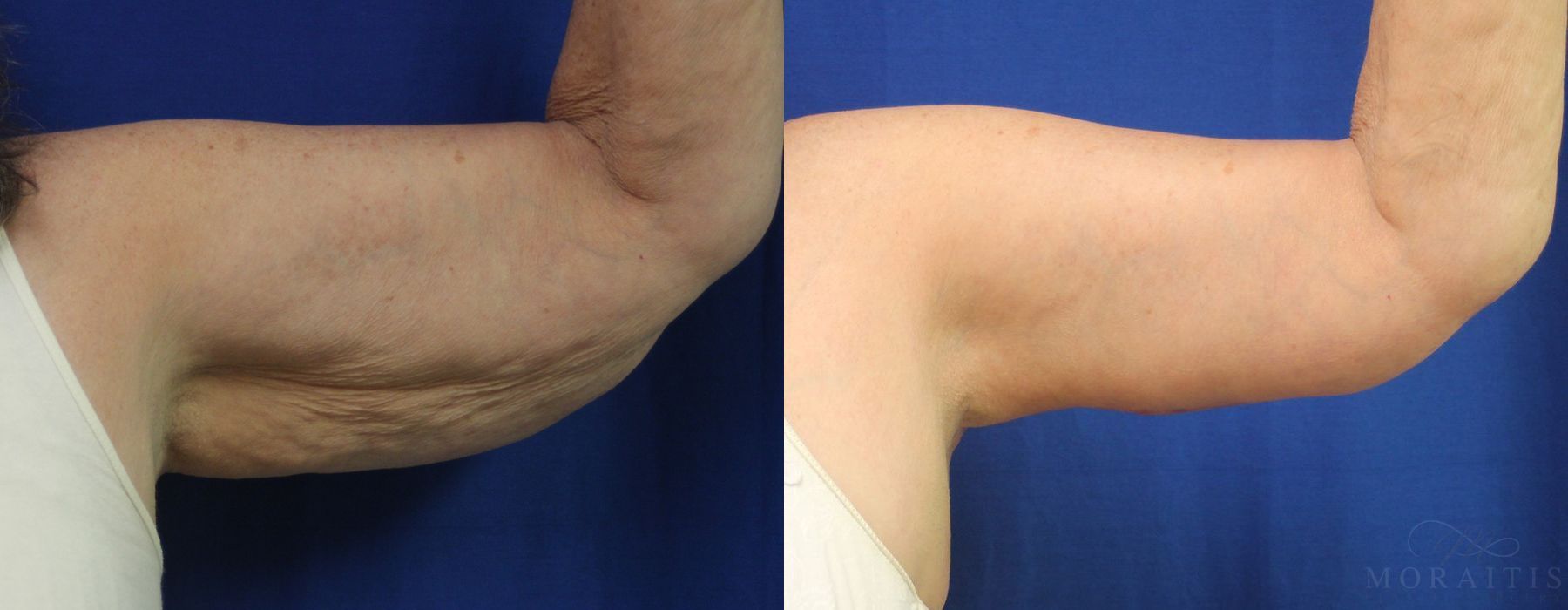 Arm Lift - Case 15296