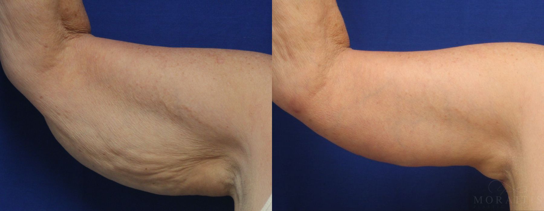 Arm Lift - Case 15281