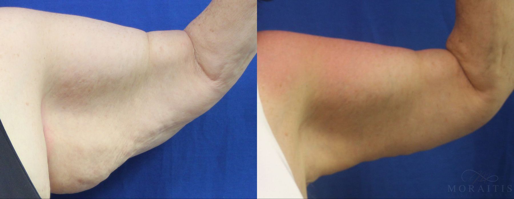 Arm Lift - Case 15280