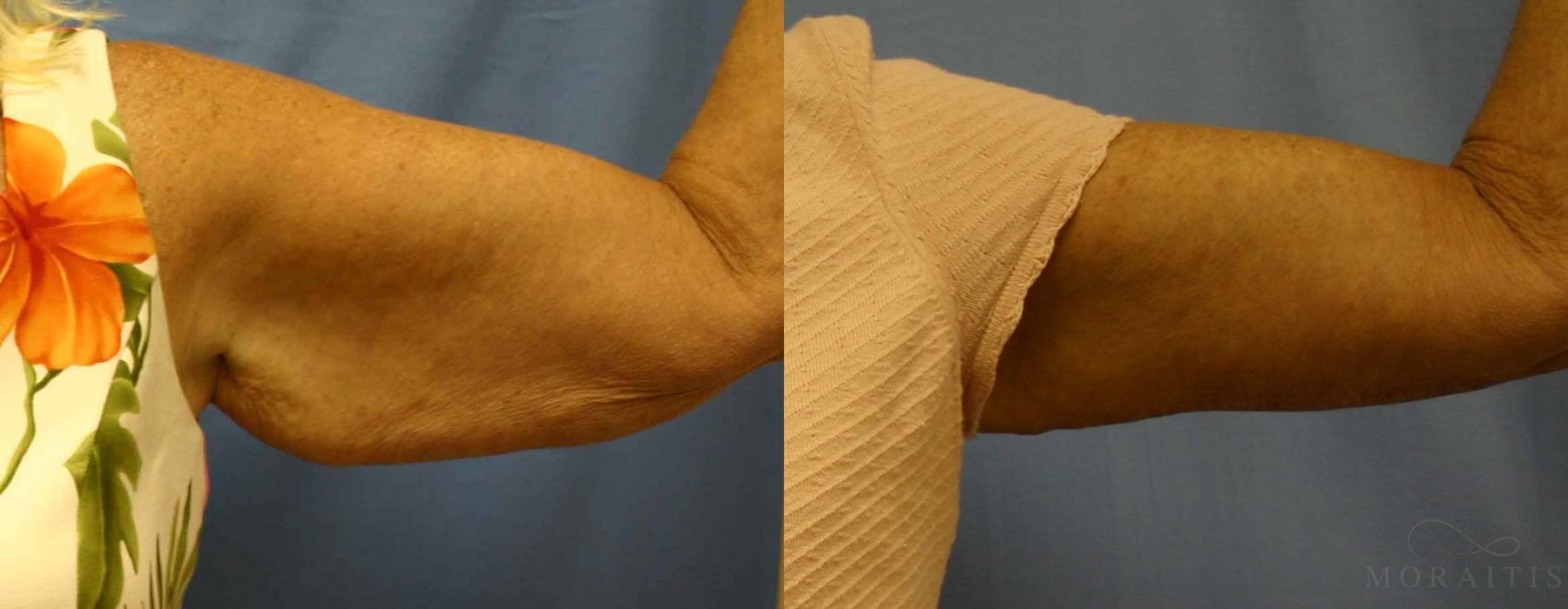 Arm Lift - Case 15291