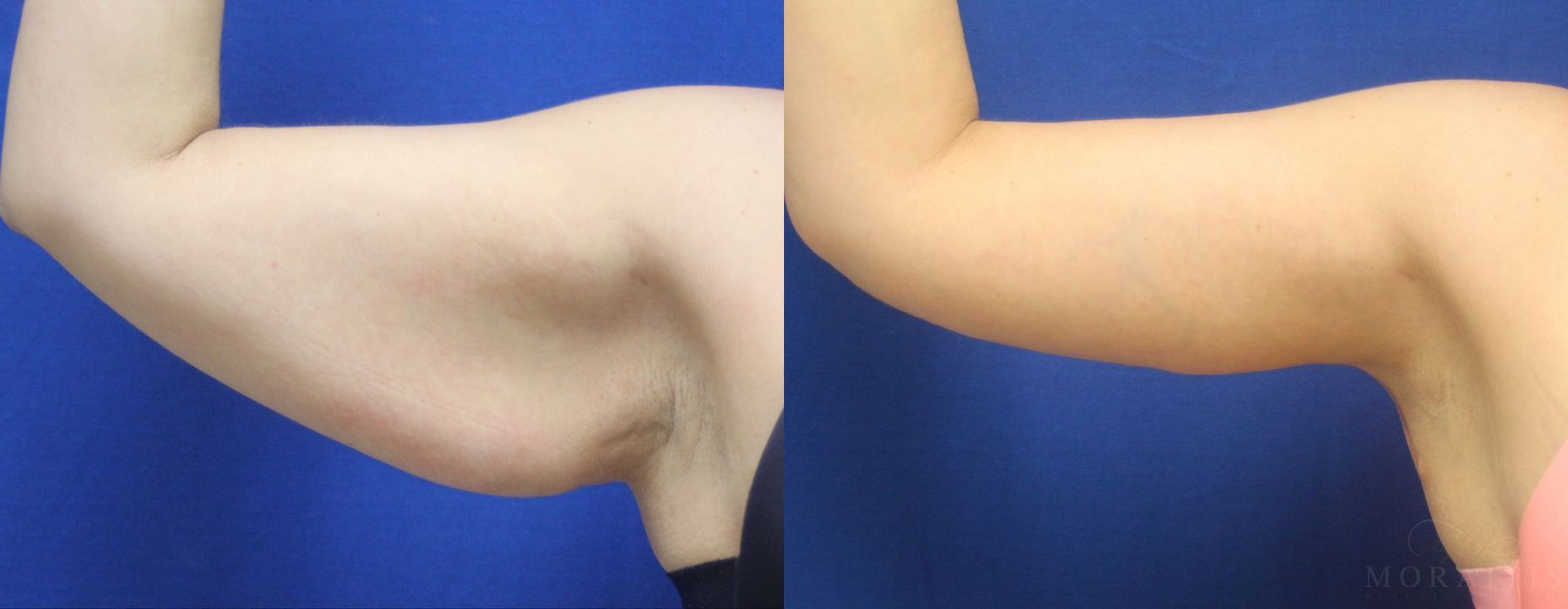 Arm Lift - Case 15288