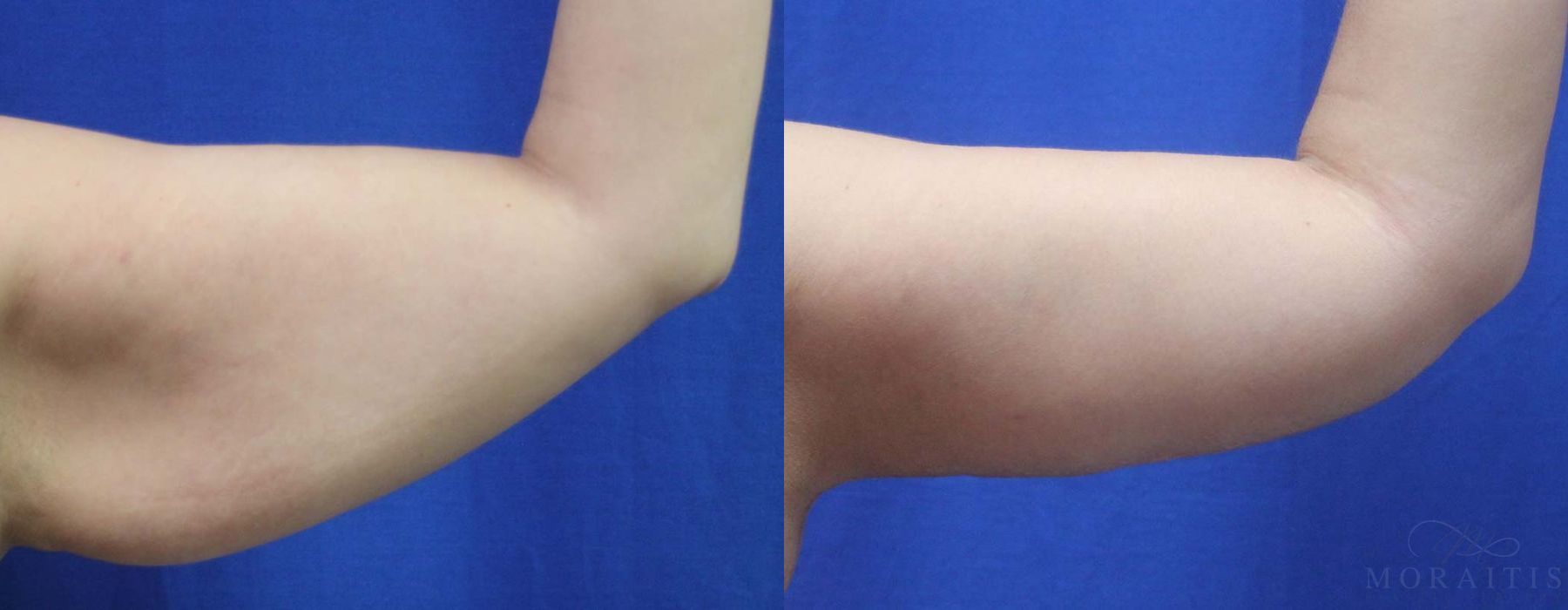 Arm Lift - Case 15295