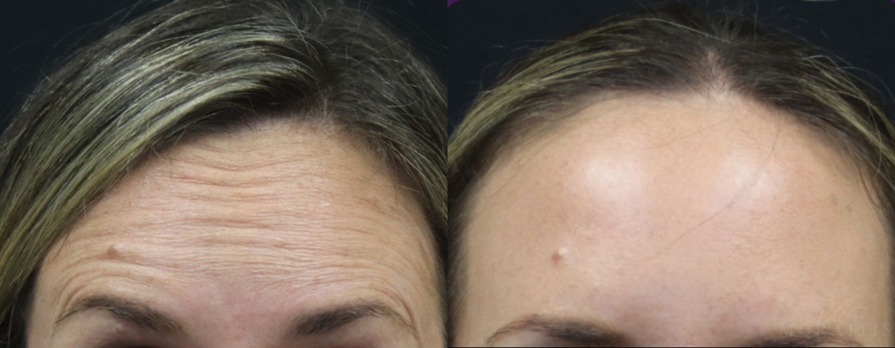 BOTOX Cosmetic - Case 15476
