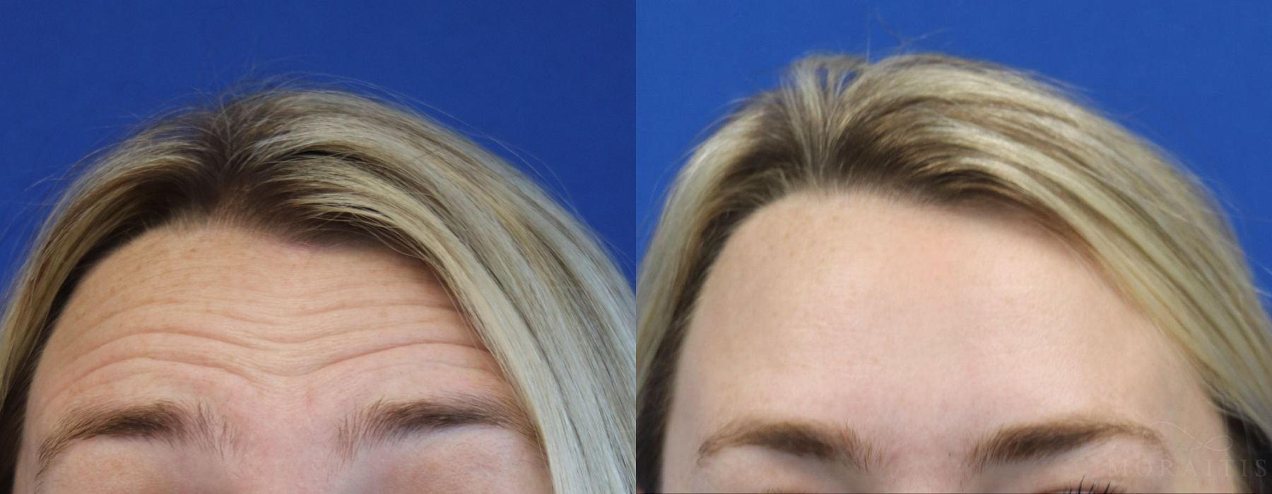 BOTOX Cosmetic - Case 15477