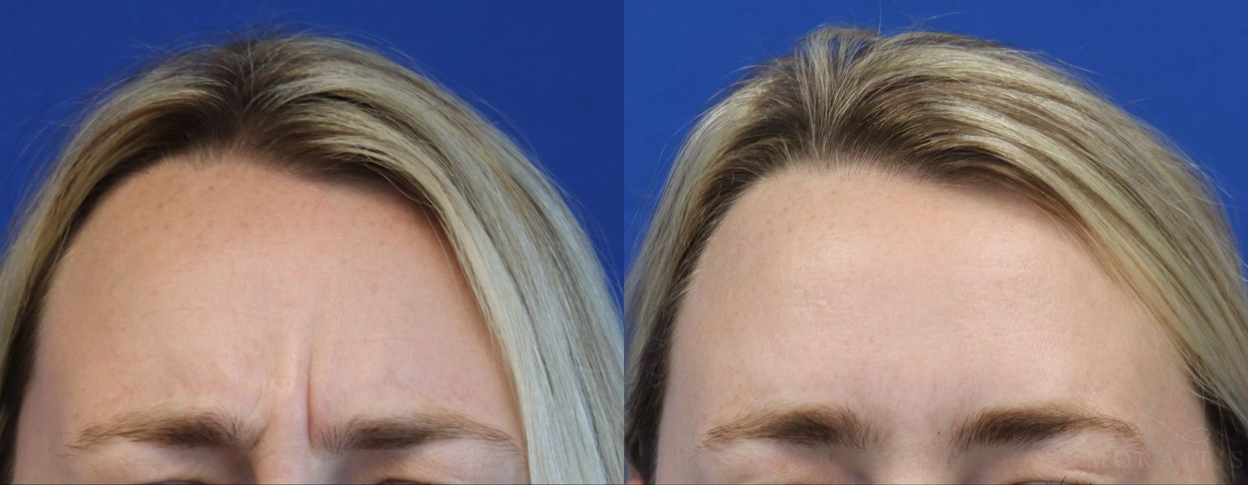 BOTOX Cosmetic - Thumbnail 2