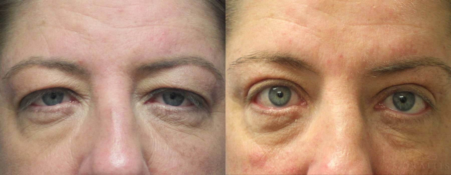 Blepharoplasty Upper Eyelids - Case 15530