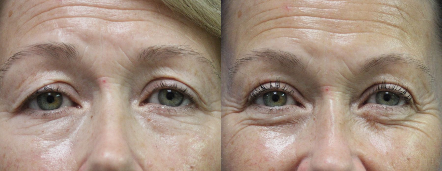 Blepharoplasty Upper Eyelids - Case 15592